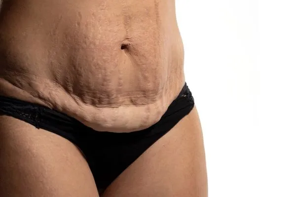 Lost the Weight but Not the Loose Skin? 1 image of womans stomach after weight loss showing loose skin Sunderland
